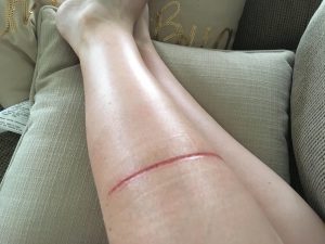flexi leash injuries
